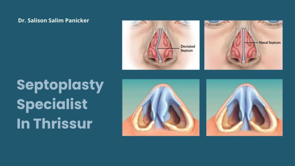 Septoplasty Specialist in Thrissur | Expert Nasal Surgery & Care